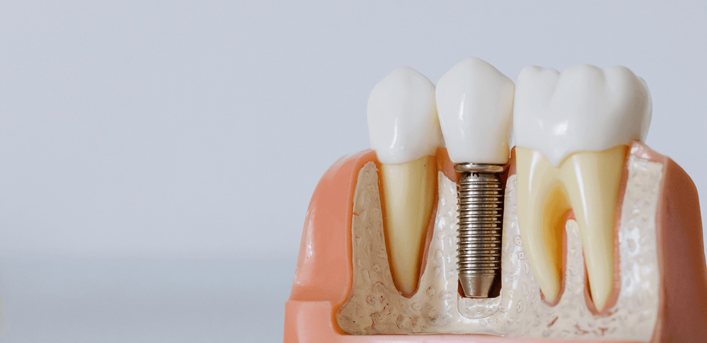 Dental Implants
